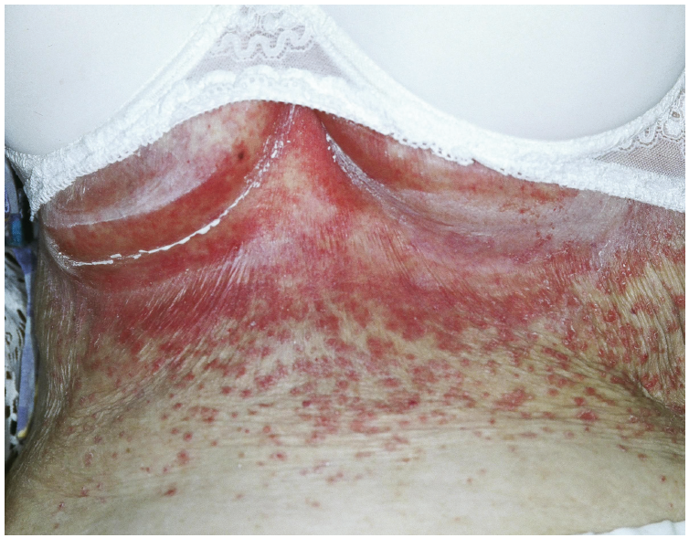 Diagnosis and Management of Candida of the Nipple and Breast
